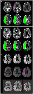 Comparison of two automated CT perfusion software packages in patients with ischemic stroke presenting within 24 h of onset